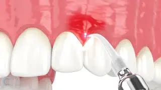 Entfernung von Zysten animation - City Dental Clinic Bratislava