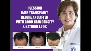 Hair transplant before and after RESULTS - STRIP 2605, 9 months after 1 SESSION