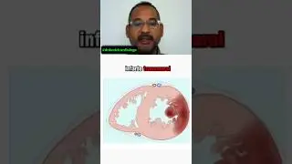 🚨STEMI: Reconoce el Infarto con elevaci&oacute;n del ST 💔 #drdanielcardiologo #doctor #infarto