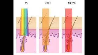 Laser Hair Reduction | Diode, IPL, Alexandrite,ND Yag @DTC skin clinic, Dr. Rohit Goel M.D. GIADA