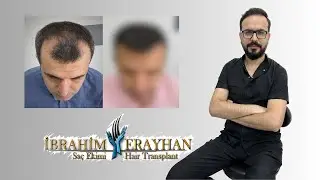 Saç Ekimi İle Gelen Doğal Ön Hat Görünümü | Natural Front Line Appearance With Hair Transplantation