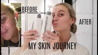 HOW DERMALOGICA SAVED MY SKIN!