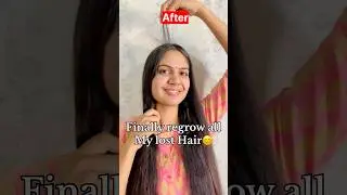 How to reduced Hairfall & regrow lost Hair | my Hairloss🥺 to HairGrowth journey #shorts #hairfall