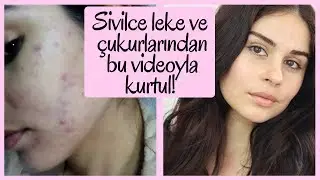 SİVİLCE İZLERİ ve ÇUKURLARIMDAN NASIL KURTULDUM ? : CİLT LEKELERİNDEN KURTULMA YÖNTEMLERİ