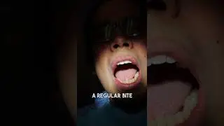 Checking for Proper Bite: What to Expect?