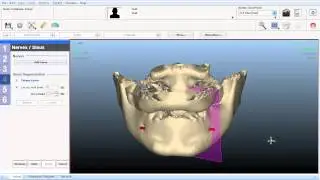NemoScan Implantology v10