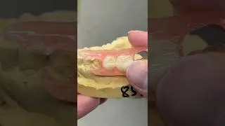 FiberFlex Unilateral #dental #teeth #smile #lsk121shorts #shorts #shortvideo #partial #dentures
