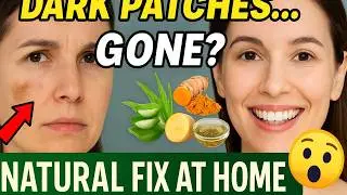 How to Treat Melasma Naturally  Remove Dark Spots & Skin Patches Fast