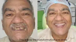 Complete Smile Makeover