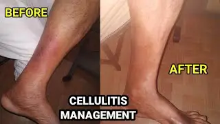 Ayurvedic management of cellulitis | Single case study