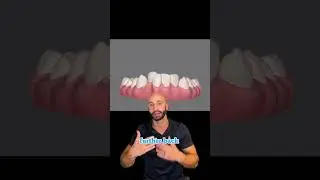 Invisalign Before and After Timelapse. 2023