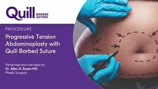 Abdominoplasty Progressive Tension Technique by Dr. Allen Rosen