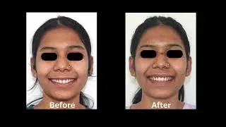 Only after 7 months of braces treatment
