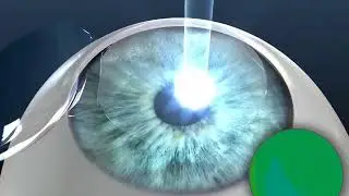 How CustomVue LASIK Treatment Works