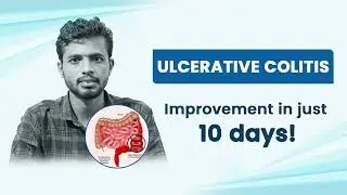 Ulcerative Colitis Relieved in Just 10 Days | A Success Story of Modern Homeopathy Treatment