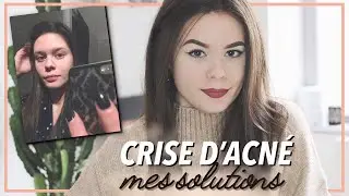 MA CRISE D'ACNÉ, et mes solutions.