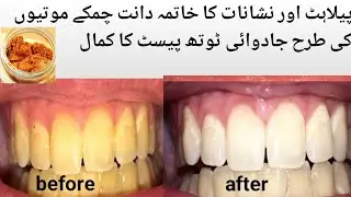 Teeth Whitening Home Remedy|EasyTeeth Whitening |Theeth Whitening with Alum At Home|