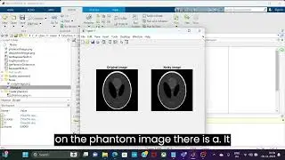 Speckled ultrasound denoising: digital image processing