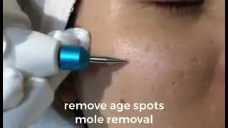 Fibroblast Plasma Pen