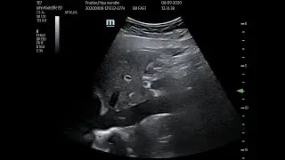 POCUS WEBINAR 9th September 2020 Oxford A&E