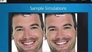 PreVu Smile Simulation Software - The Ultimate Virtual Consult