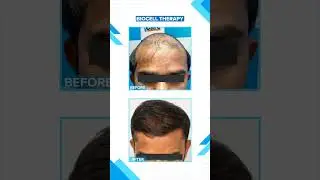 Take a peek at the remarkable transformation our Biocell 360&deg; #shorts #hairgrowth #vcare