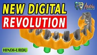 Exocad Implant Screw retained All on 4 Tutorial -HINDI AND URDU