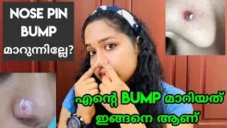 How To Get Rid Of Nose Piercing Bump FAST!! |Home remedy for nose piercing bump