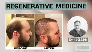 Great Regenerative Medicine Results on Hair Loss Patient - Dr. Cole