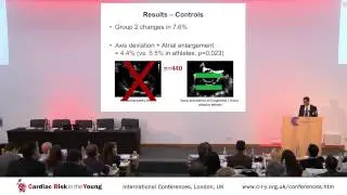 Athlete's with ECG abnormalities beyond T wave inversions