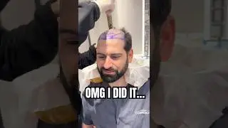 I Got A Hair Transplant in Turkey and This Happened!!
