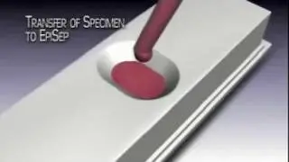 EpiSep Demonstration of Circulating Tumor Cell Isolation