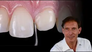 Veneer Video Tutorial [preview]