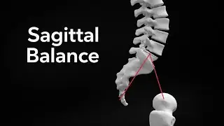 Sagittal Balance: Parameters, Measurement, Compensation, Rousoully Types.