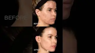 #Shorts EFRESH AND RENEW WITH REVEPEEL | Dr. Jason Emer