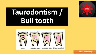 Taurodontism/ Bull teeth ; Oral pathology - introduction, classification, radiographic features