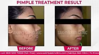 Acne Treatment Success Story | Clear Skin Journey with Sakhiya Skin Clinic