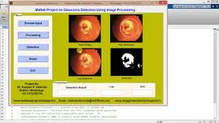 Matlab code for Glaucoma Detection using Image Processing IEEE Project