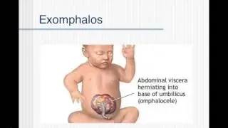 Neonatal apnoea and URTI