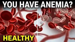 Iron Deficiency Anemia 3D Animation: What Happens Inside Your Blood &ndash; 9.3% of Americans Are Affected