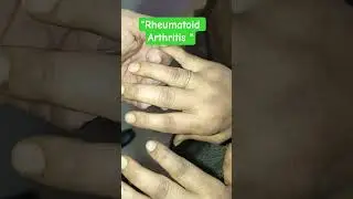 RHEUMATOID ARTHRITIS #healthawareness #rheumatoidarthritis #deformity #rheumatology