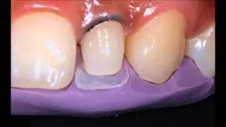 Dr Anthony Tay - 3M ESPE Filtek Z350XT Anterior Composite Layering of a Peg Lateral Incisor