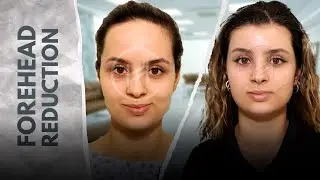 Female Forehead Reduction Before and After | Unedited Result at Heva Clinic #foreheadreduction