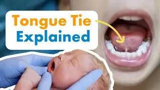Короткая уздечка языка у детей: что нужно знать родителям