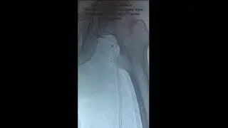 Control 11F Mechanical Thrombectomy System DVT May-Thurner