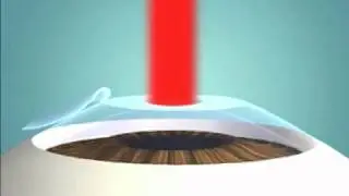 02 LASIK microkeratome