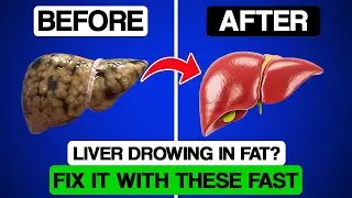 Top 10 Foods That Cleanse a Fatty Liver FAST &ndash; Eat These Before It&rsquo;s Too Late