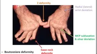 Rheumatoid arthritis