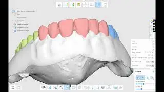 Denture Creation in Medit