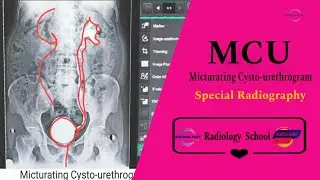 Micturiting Cystourethogram( MCU)/ MCU test procedure in radiology/ Urinary bladder test procedure
